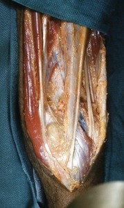 Natural color photograph of dissection of the popliteal fossa, showing popliteal vessels and the tibial nerve