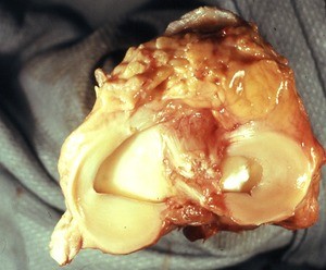 Natural color photograph of dissection of the right knee, superior view, showing the medial and lateral meniscus