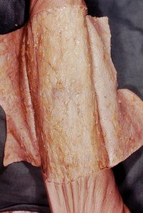 Natural color photograph of dissection of the arm, showing superficial fascia