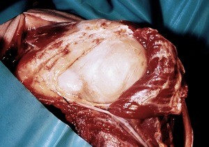 Natural color photograph of dissection of the left shoulder, superoanterior view, with the skin and deltoid muscle reflected to reveal the glenohumeral joint capsule