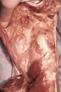 Natural color photograph of dissection of the popliteal fossa, with the joint cavity exposed