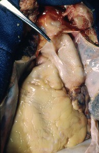 Natural color photograph of dissection of the thorax, anterior view, with the pericardium cut and retracted to expose the heart