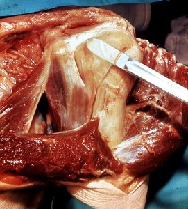 Natural color photograph of dissection of the left shoulder, anterior view, with the deltoid muscle reflected to expose the surgical head of the humerus, the axillary nerve, and the fibrous capsule of the glenohumeral joint