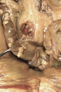 Natural color photograph of dissection of the lower abdomen and pelvic cavity, anterior view, showing pelvic and abdominal viscera