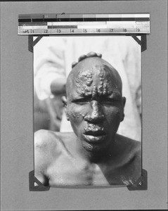 Face of a leper suffering from lepromatous leprosy, Nyasa, Tanzania, 1929