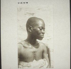 Man with leprosy on his face and chest