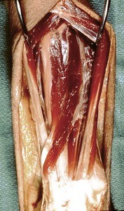 Natural color photograph of dissection of the left forearm, posterior view