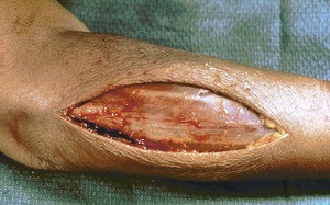 Natural color photograph of dissection of the right forearm, posterior view, initial incision