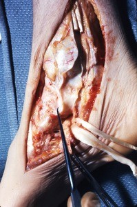 Natural color photograph of dissection of the right ankle, medial view, with the tibialis posterior t. and the flexor digitorum longus t. cut and reflected