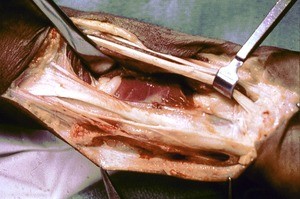 Natural color photograph of dissection of the forearm, anterior view, exposing the pronator quadratus