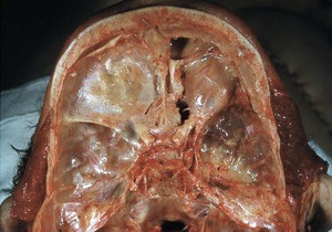 Natural color photograph of dissection of the anterior and middle cranial fossa, superior view, showing the superior surface of the orbit