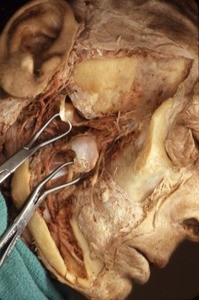 Natural color photograph of dissection of the temporal fossa, lateral view, showing the temporomadibular joint