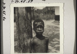 Child with yaws in Hohoe