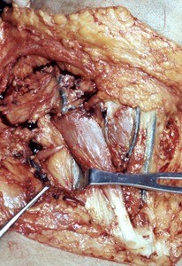 Natural color photograph of dissection of the right neck, anterior view, with the sternocleidomastoid muscle retracted to expose the inferior belly of the omohyoid muscle