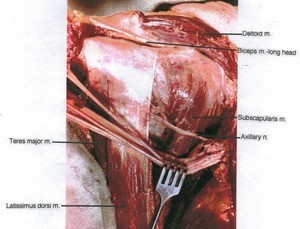 Natural color photograph of dissection of the right axilla, anterior view, showing major muscles and the axillary nerve; the other branches of the brachial plexus have been retracted