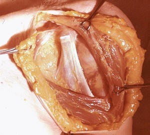 Natural color photograph of dissection of the left shoulder, anterior view, with the deltoid muscle retracted along the deltopectoral groove to expose the tendons of the short head of the biceps brachii muscle and coracobrachialis muscle