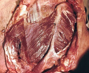 Natural color photograph of dissection of the left back, posterior view, with the trapezius and major rhomboid muscles reflected to expose the serratus posterior superior muscle and infraspinatus muscle