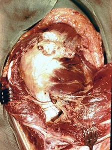 Natural color photograph of dissection of the left shoulder, lateral view, with the deltoid muscle reflected to reveal the rotator cuff muscles and axillary nerve