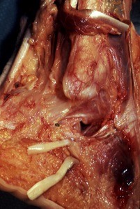 Natural color photograph of dissection of the right ankle, lateral view, with the fibularis longus t. and the fibularis brevis t. cut