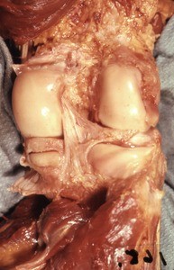 Natural color photograph of dissection of the popliteal fossa, showing the medial and lateral condyles of the femur and tibia, and the posterior cruciate ligament
