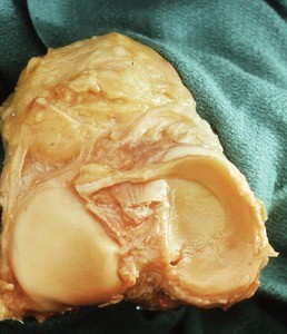 Natural color photograph of the left knee, superior view, showing the tibial table