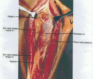 Natural color photograph of dissection of the left forearm, posterior view, showing extensor muscles and their innervation; the extensor digitorum muscle has been dissected away