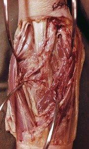 Natural color photograph of dissection of the right cubital fossa, anterior view