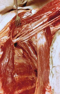 Natural color photograph of dissection of the left axilla, anterior view