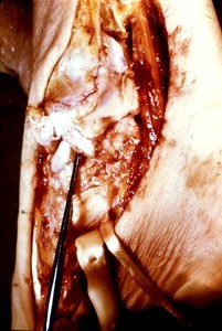 Natural color photograph of dissection of the right ankle, medial view, with the tibialis posterior t. and flexor digitorum longus t. cut and reflected