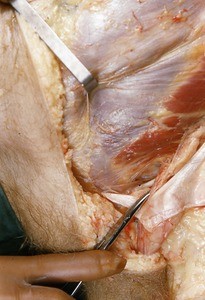 Natural color photograph of dissection of the right inguinal region, anterior view