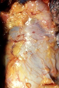 Natural color photograph of dissection of the thorax, anterior view, with the rib cage removed to expose the pericardium