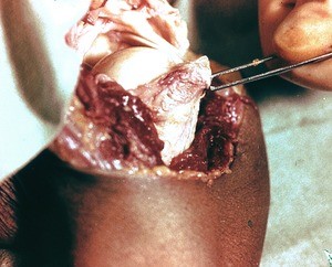 Natural color photograph of dissection of the right shoulder, posterolateral view, with the musculature removed and the joint capsule cut and retracted to reveal the head of the humerus