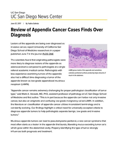 Review of Appendix Cancer Cases Finds Over Diagnosis