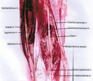 Natural color photograph of right knee, posterior view, showing muscles, nerves, veins and tendon