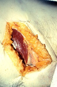 Natural color photograph of the left inguinal region, anterior view