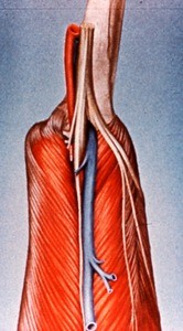Illustration of right popliteal region (posterior of knee joint) dissected to show medial and lateral gastrocnemius muscles, tibial nerve bifurcation giving rise to sural nerve and common fibular (peroneal) nerve, tibial artery, small saphenous vein