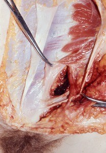 Natural color photograph of dissection of the left inguinal region, anterior view, emphasizing the deep inguinal ring