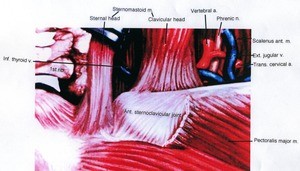 Illustration of lower left portion of neck, anterior view, showing muscles, joint, bone, nerve, vein and arteries