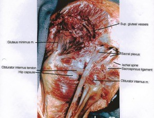 Natural color photograph of dissection of the left hip and buttock, posterior view, showing the sacral plexus and sciatic nerve