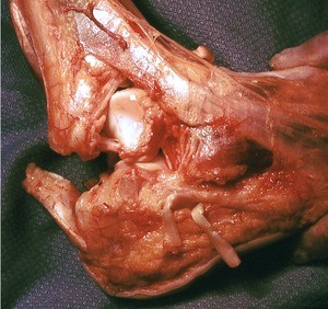 Natural color photograph of dissection of the right foot, lateral view, with the calcaneal, fibularis brevis, and fibularis longus tendons cut to expose the underlying bone structure
