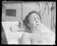 Clara Phillips' murder victim Alberta Meadows on autopsy table shown from shoulders up, Los Angeles, Calif., 1922