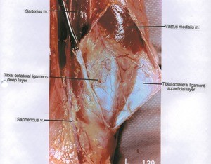 Natural color photograph of left knee, anteromedial view, showing muscles, vein and tibial collateral ligaments