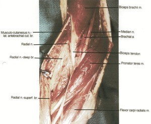 Natural color photograph of dissection of right cubital region showing deep structures, including the median nerve, the branching of the radial nerve, and related musculature with the brachioradialis muscle reflected