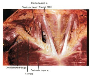 Natural color photograph of dissection of the neck, anterior view, showing the sternocleidomastoid muscle along with other muscles in relation to the clavicle