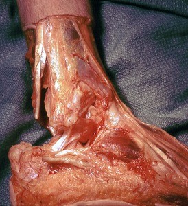 Natural color photograph of dissection of the right foot, lateral view, with the fibularis longus and fibularis brevis tendons reflected to expose the calcaneofibular ligament