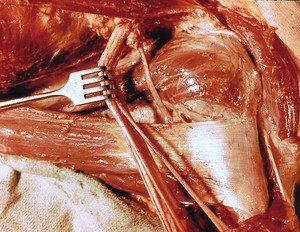 Natural color photograph of dissection of the left axilla, anterolateral view, emphasizing the axillary nerve, with the remaining branches of the brachial plexus retracted
