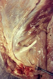 Natural color photograph of dissection of the left inguinal region, anterior view