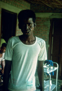 Diasserie, Bangladesh 1990: "Spedalskhed - den gamle svøbe" - Nr. 07: Patient med spedalskhedsknuder. Denne patient har ikke selv nogen modstandskraft, og hos ham har bacillerne sat sig som knuder i huden, der er begyndt at briste. Når symptomerne optræder på denne måde, taler man om knude spedalskhed. I modsætning til sår forårsaget af skader på følelsesløse hænder og fødder, udskiller disse knuder spedalskhedsbaciller, og gør derved patienten yderligere smittefarlig