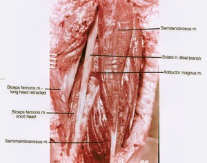 Natural color photograph of dissection of the left popliteal fossa, posterior view, showing muscles and nerves with the long head of the biceps femoris muscle retracted