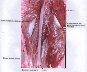 Natural color photograph of left lower thigh, posterior view, showing nerves, muscles and tendon with bicep femoris, semitendinosus and semimembranosus reflected